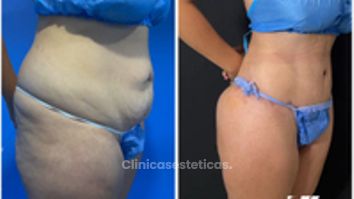 Abdominoplastia - Dr. Zamir Páez