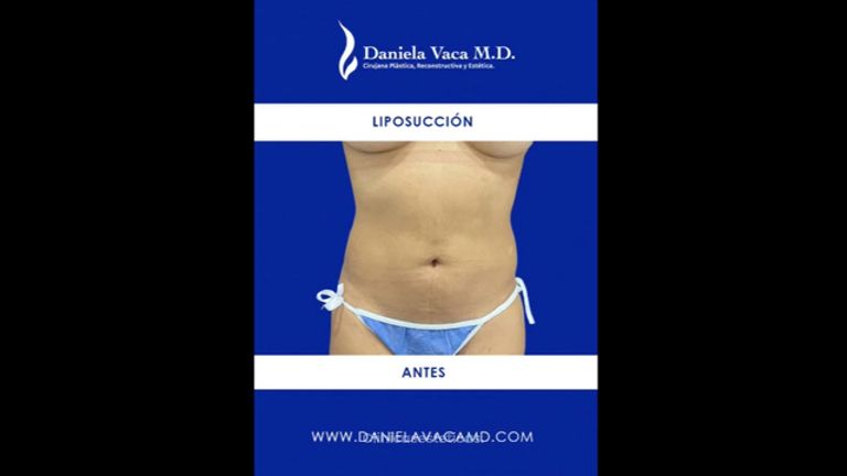 Liposucción - Dra. Daniela Stephania Vaca Grisales