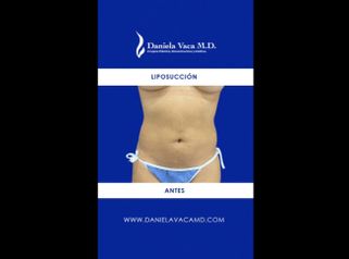 Liposucción - Dra. Daniela Stephania Vaca Grisales