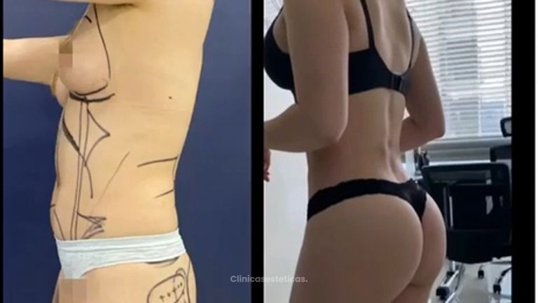 Antes y después Gluteoplastia