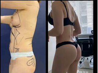 Antes y después Gluteoplastia