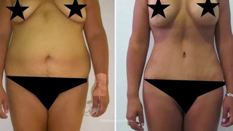 Abdominoplastia - Tummy Tuck - Dr. Gonzalez Legarda
