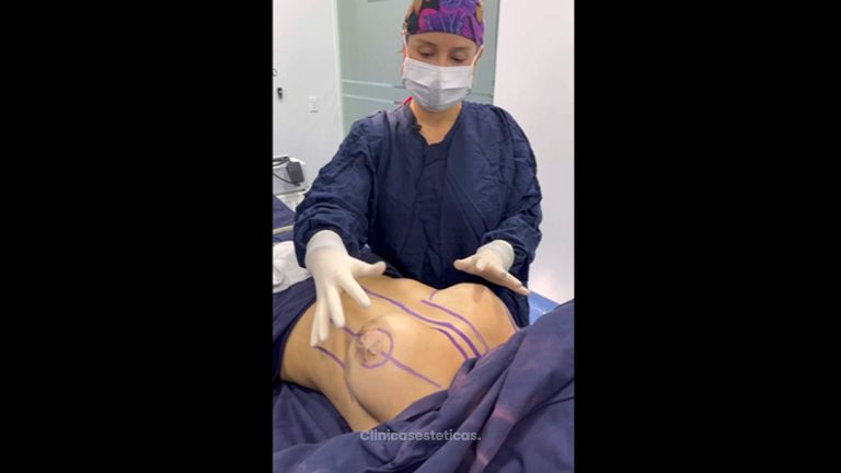 Cambio de implantes - Dra. Daniela Stephania Vaca Grisales
