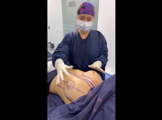 Cambio de implantes - Dra. Daniela Stephania Vaca Grisales