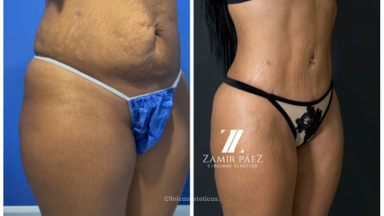 Liposucción - Dr. Zamir Páez