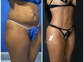 Liposucción - Dr. Zamir Páez
