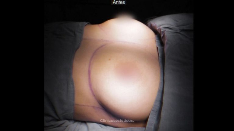 Mamoplastia de aumento - Dr. Luis Fernando Reyes