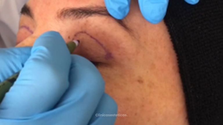 Blefaroplastia Superior - Doctora Alexandra Mora