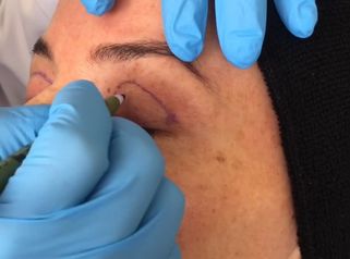 Blefaroplastia Superior - Doctora Alexandra Mora