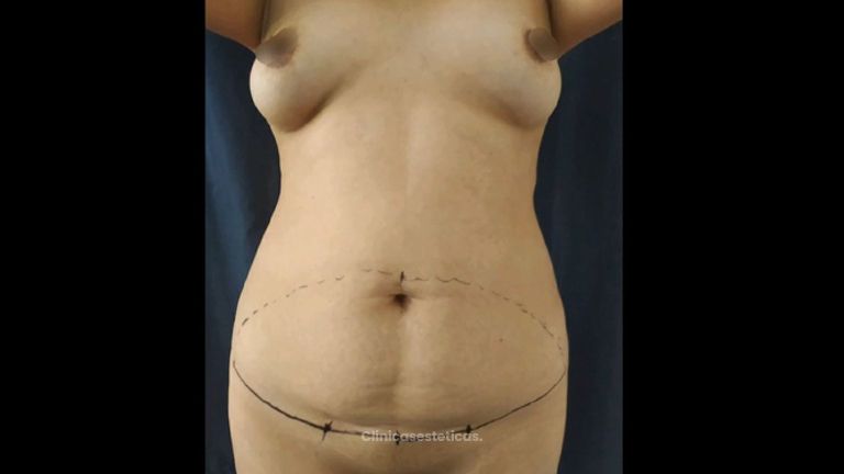 Lipoescultura - Dr. Juan A. Sanabria