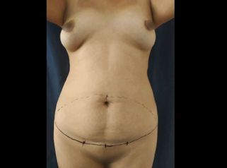 Lipoescultura - Dr. Juan A. Sanabria