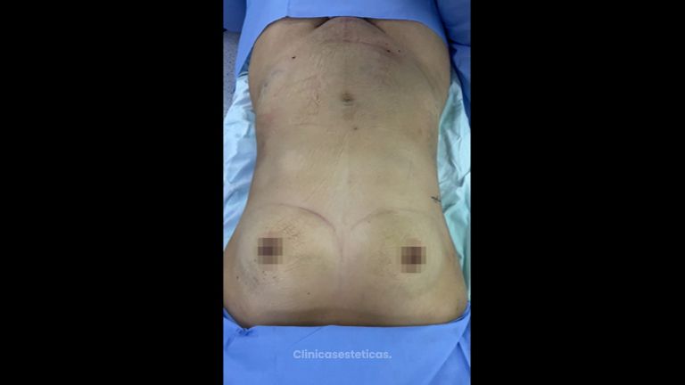 Liposucción - Dr. Luis Fernando Reyes & Dra. Nicole Echeverry