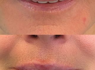 Relleno de Labios - Doctora Alexandra Mora