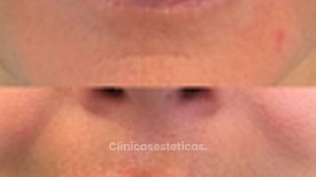 Relleno de Labios - Doctora Alexandra Mora