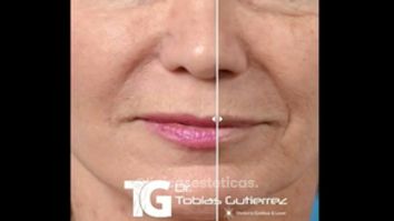 Aumento de labios 