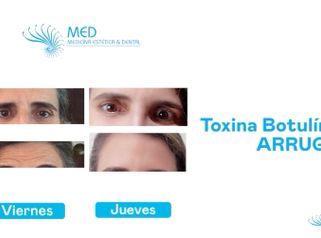 Toxina Botulínica - Dr. Fernando Pinedo Bischoff