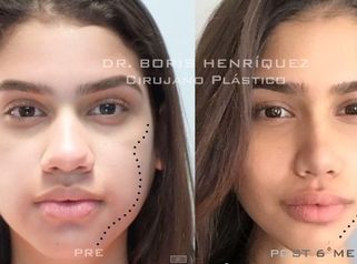 Relleno Facial Pómulos, Rinoplastia y Bichectomía (Cachetes)