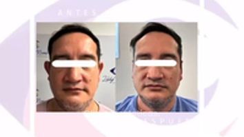 Otoplastia - Dra. Lady Mora y Dr. Juan Felipe Acosta