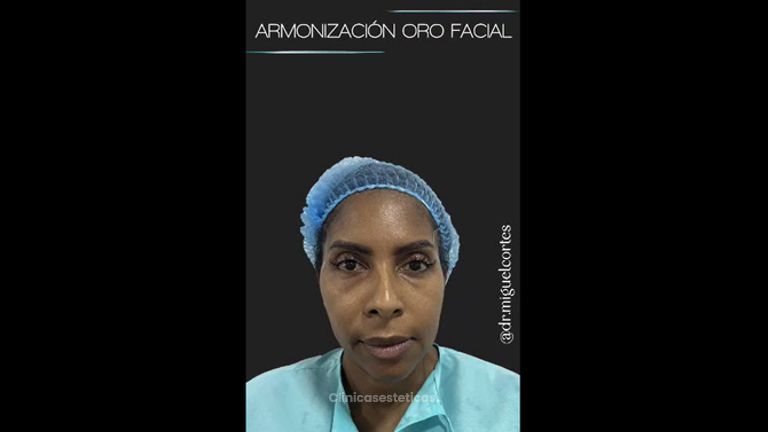 Armonización facial - Dr. Miguel Ángel Cortés
