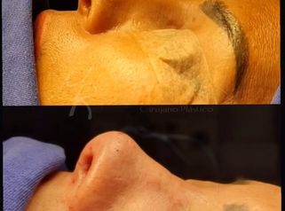Rinoplastia - Dr. Milton Horacio Rincón Carranza