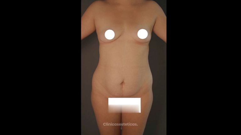 Liposucción - Dr Fulvio Alexander CorreaDr Fulvio Alexander Correa