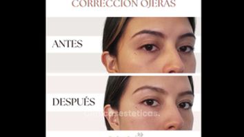 Eliminar ojeras - Dra Fanny Rosero Narváez