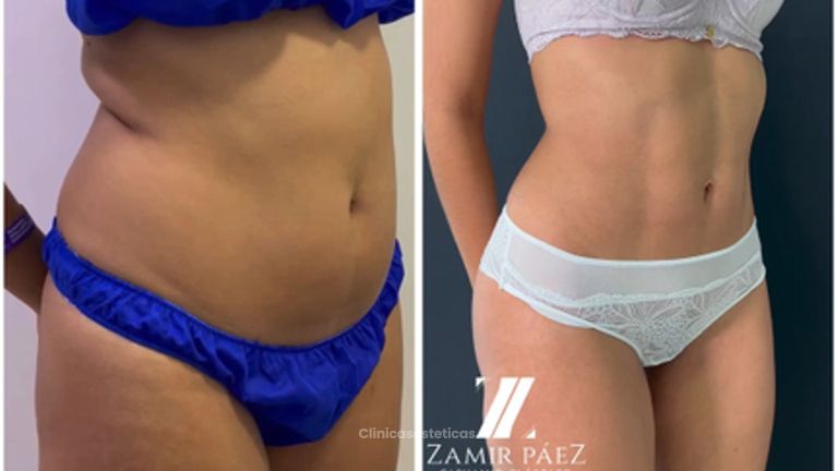 Liposucción - Dr. Zamir Páez