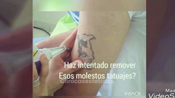 Borrar Tatuajes