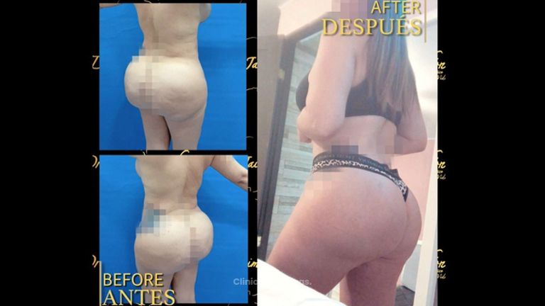 Gluteoplastia - Dr. Jaime Pachón