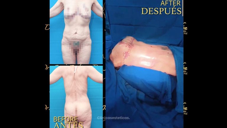 Liposucción - Dr. Jaime Pachón