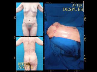 Liposucción - Dr. Jaime Pachón