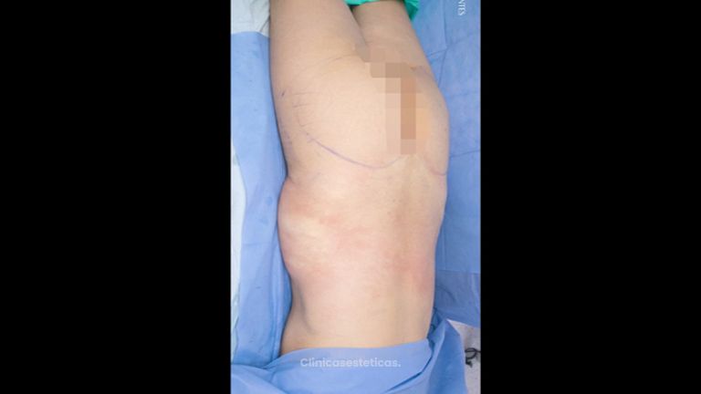 Gluteoplastia - Dr. Luis Fernando Reyes & Dra. Nicole Echeverry