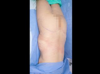 Gluteoplastia - Dr. Luis Fernando Reyes & Dra. Nicole Echeverry