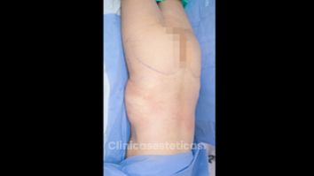Gluteoplastia - Dr. Luis Fernando Reyes & Dra. Nicole Echeverry