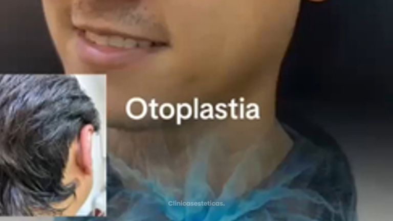 Otoplastia - Dr, Reinel Mesa