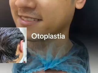 Otoplastia - Dr, Reinel Mesa