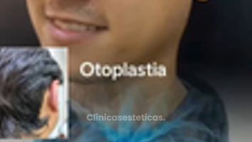 Otoplastia - Dr, Reinel Mesa