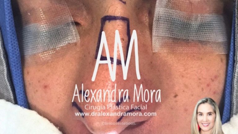 Rinoplastia - Doctora Alexandra Mora