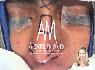 Rinoplastia - Doctora Alexandra Mora