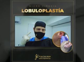 Lobuloplastia - Dr. Juan Carlos Herrera P.