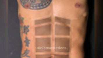 Marcación Abdominal - Dr. Juan Canencio