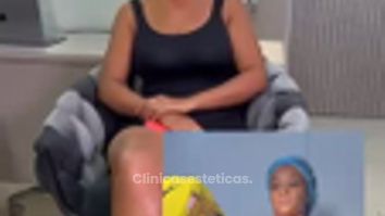 LipoAbdominoplastia - Dr. Reinel Mesa