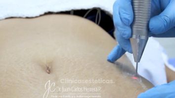 Laser Fotona Abdomen