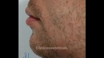 Mentoplastia - Dr. José Miguel Sandoval Rodríguez