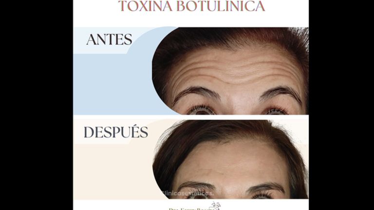 Toxina Botulínica - Dra Fanny Rosero Narváez