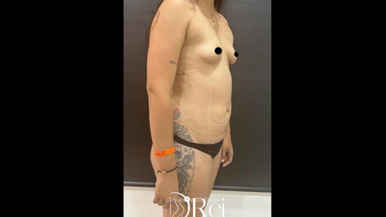 Liposucción - Dr. Reinel Mesa