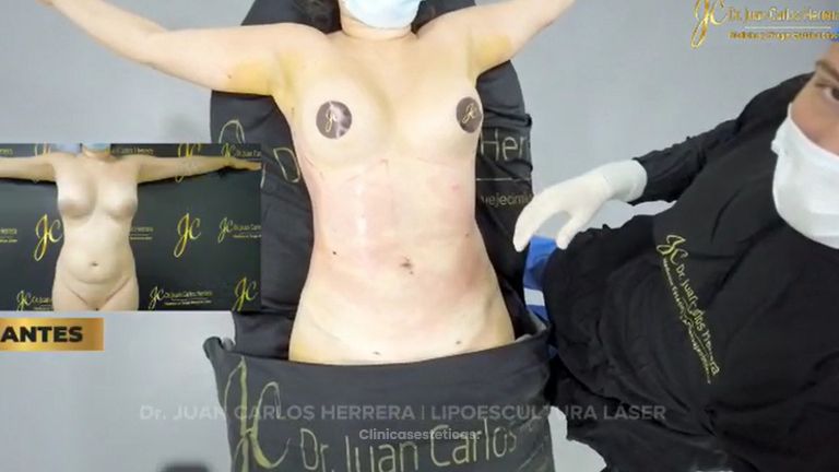 Liposucción - Dr. Juan Carlos Herrera P.