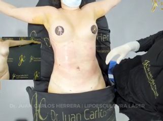Liposucción - Dr. Juan Carlos Herrera P.