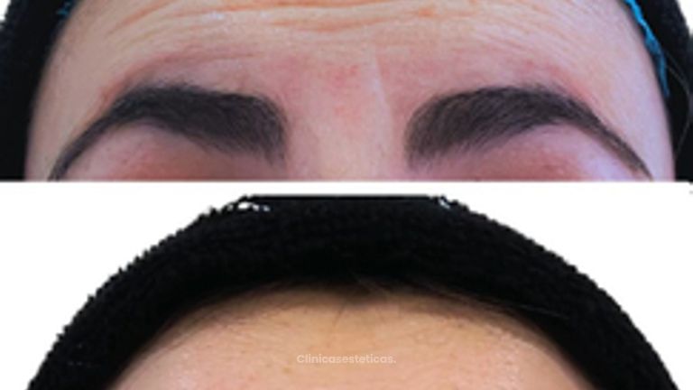 Toxina Botulínica - Doctora Alexandra Mora