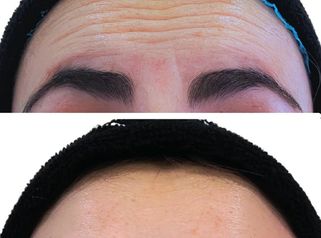 Toxina Botulínica - Doctora Alexandra Mora